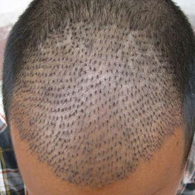 How to Prepare for a Hair Transplant Surgery
