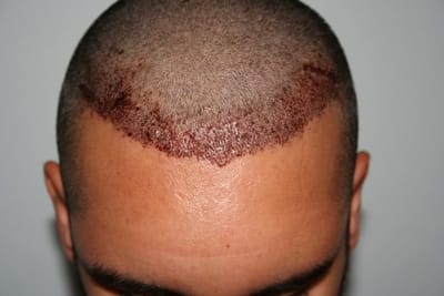 Are You Too Young For Hair Transplant?