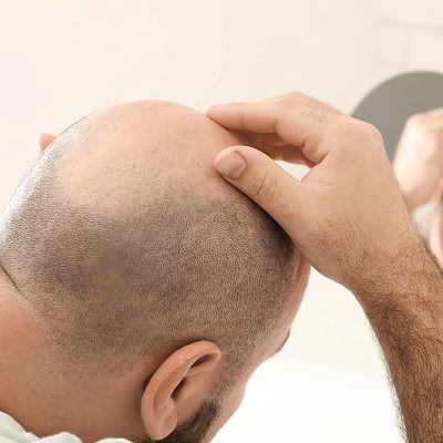 Take A Sigh of Relief - Hair Transplant Queries Answered