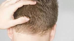 FUE Hair Transplant and Its Multiple Benefits