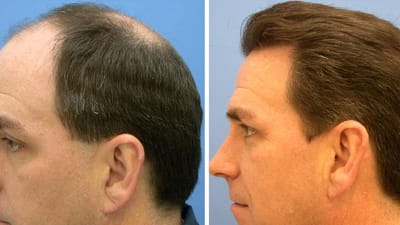 لماذا تختار عملية زراعة الشعر بالاقتطاف