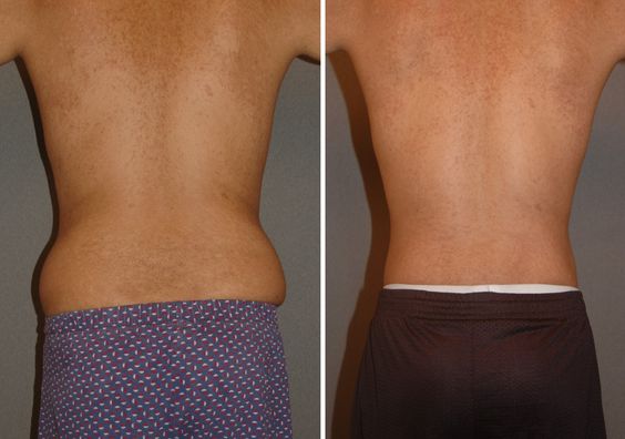 LIPO DISSOLVE