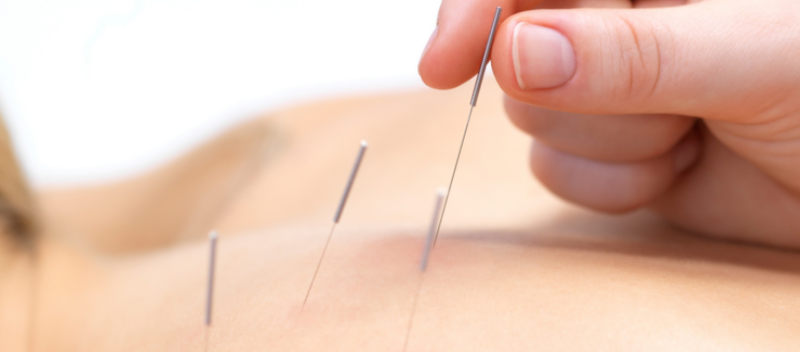 Dry Needling