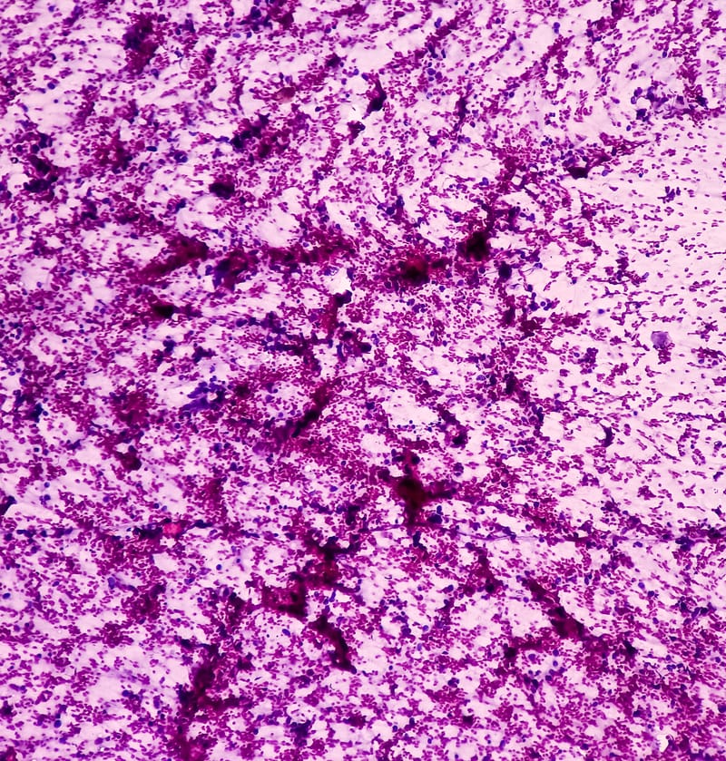 Diversity of Immune Response in Small-Cell Lung Cancer and Susceptibility to Immune Checkpoint Blockade