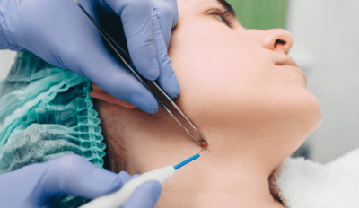 Mole Removal Product - What Is New In Mole Removal Products?