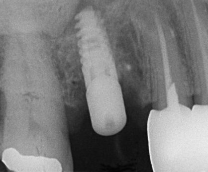 Implant fixture placement