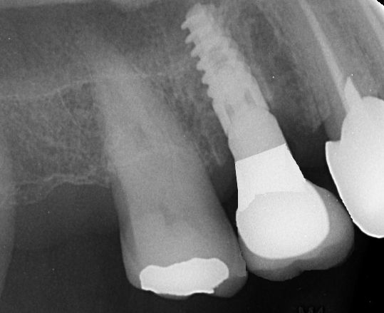 Implant crown completed