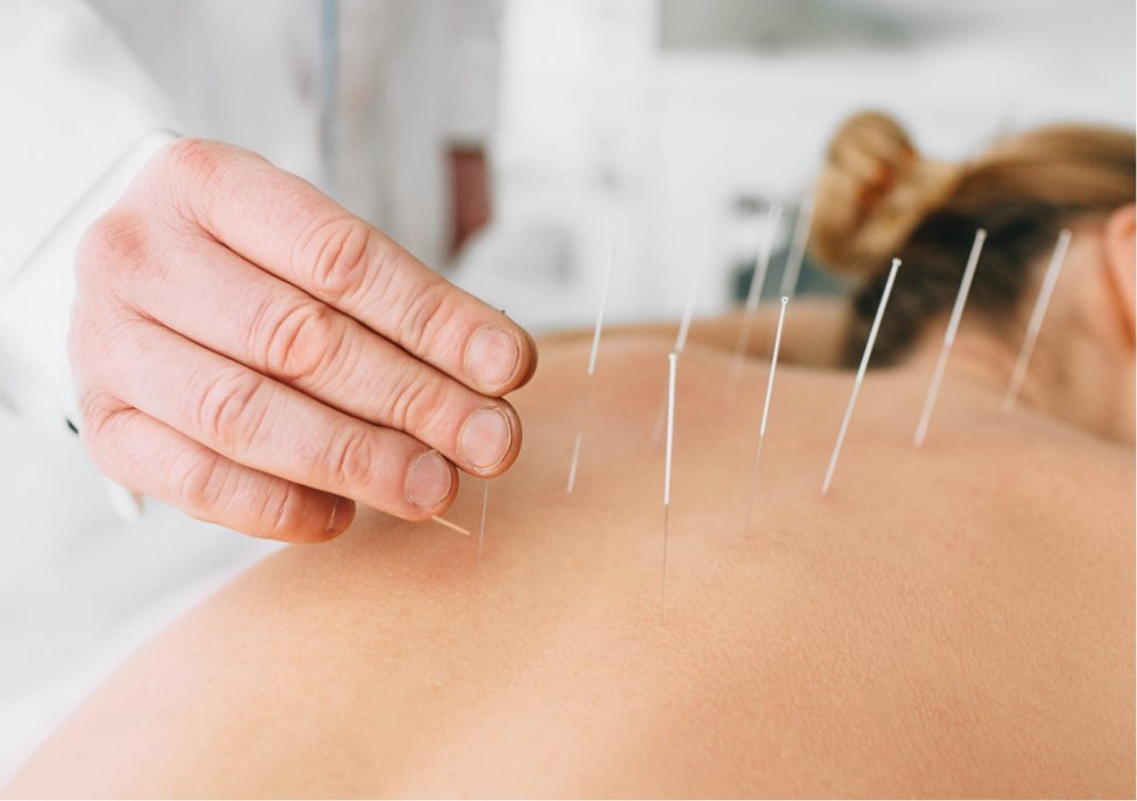 Dry Needling