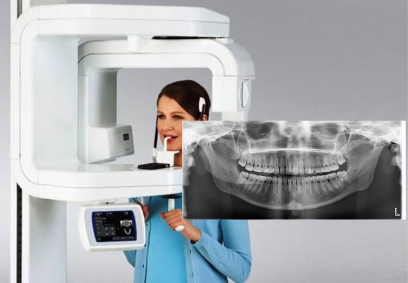Intra Oral &amp; Panoramic X-Rays