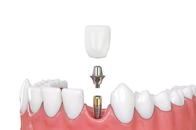 Dental Implant