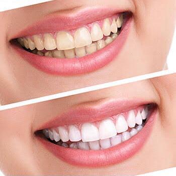 Tooth Whitening