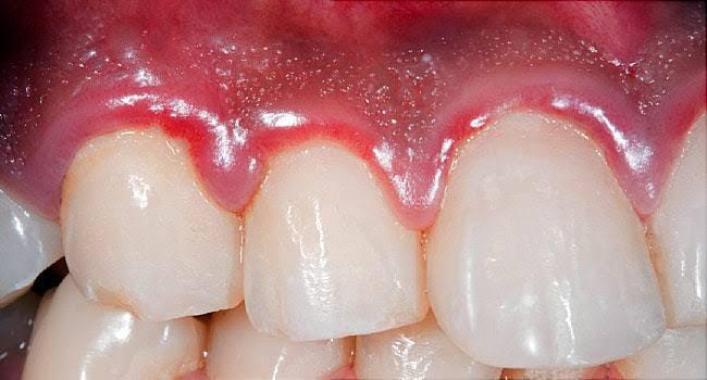 Gums Treatment