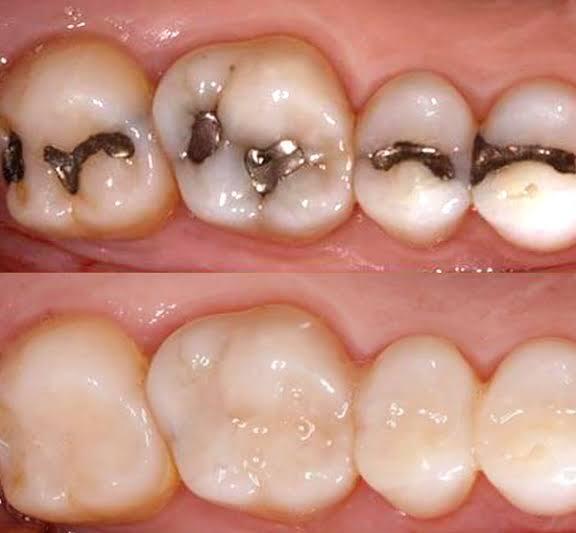White Fillings