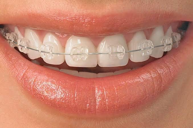 Braces, Orthodontic Treatment