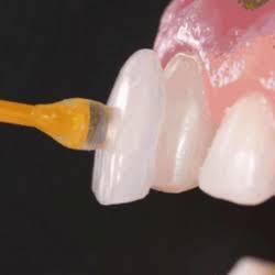 Veneers, Smile Makeover