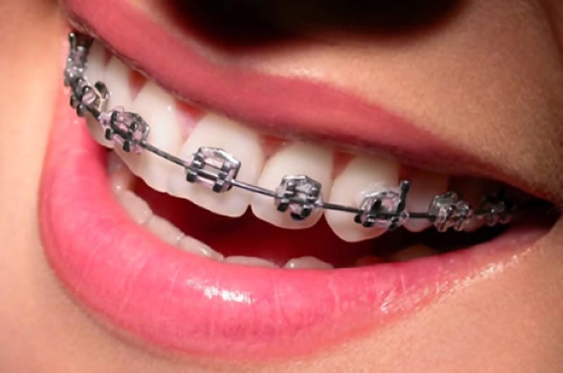 APARELHOS ORTODÔNTICOS
