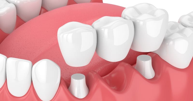 Understanding Dental Bridge Cost in Ontario: A Comprehensive Guide