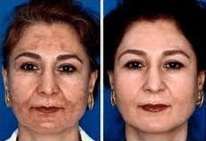 Chemical peels specialised (Pigmentation)