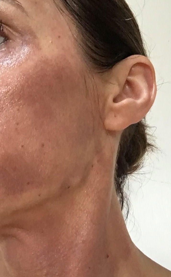 Chemical peels (medium depth)