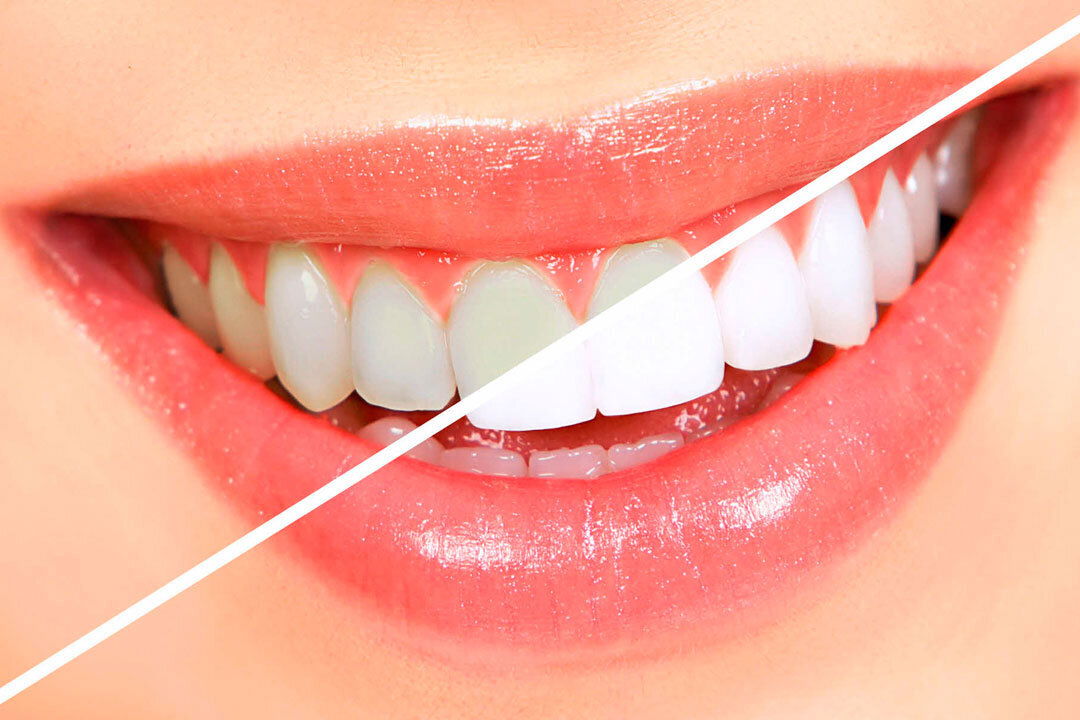 Clareamento Dental