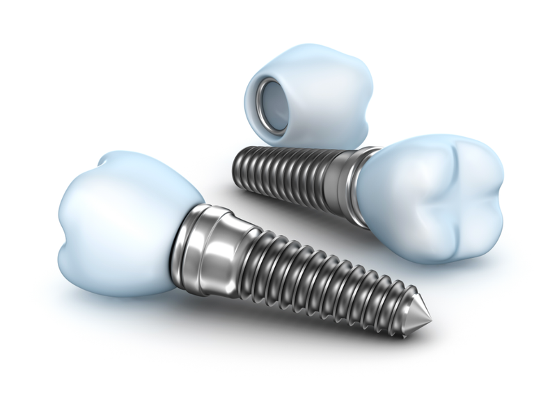Implantes Dentários