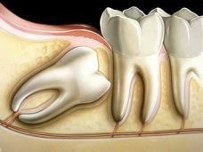 Cirurgia Oral Menor