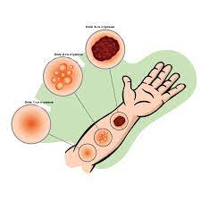 УРОК 6. ОПІКИ, ТЕПЛОВІ УДАРИ, ОБМОРОЖЕННЯ