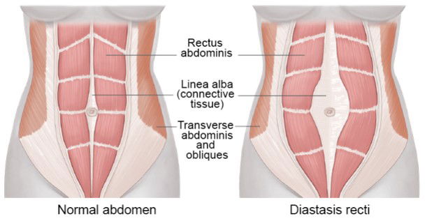 Core  and Pelvic Floor Strengthening Postpartum