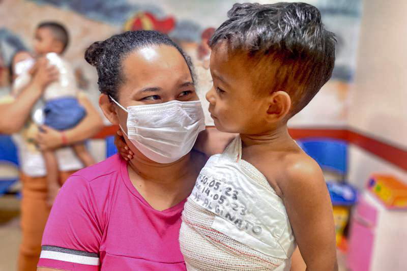 Hospital Metropolitano é referência no Norte para o tratamento de queimaduras
