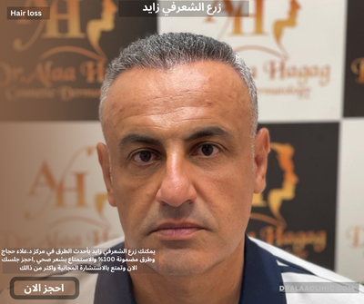 زرع الشعر في مصر
