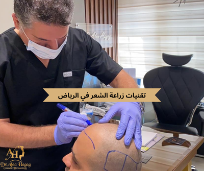 احدث طرق زراعة الشعر و افضل العروض