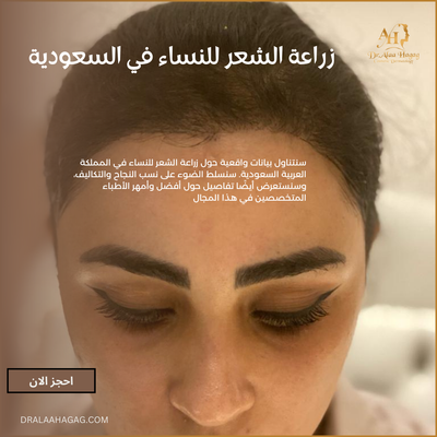زراعة الشعر للنساء