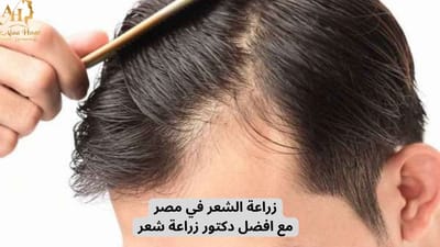 زراعة الشعر في مصر