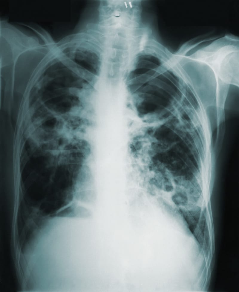 Tuberculosis Test