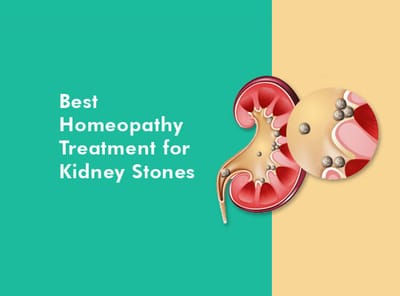 KIDNEY STONE TREATMENT image