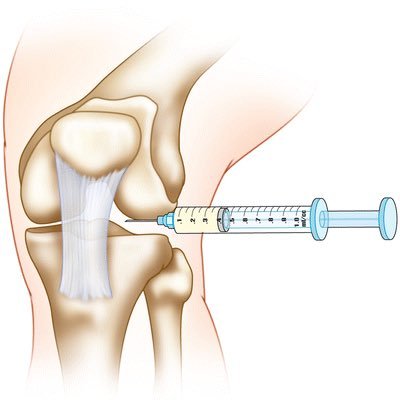 الحقن المفصلي image