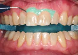 Klinikblekning med opalescence Boost