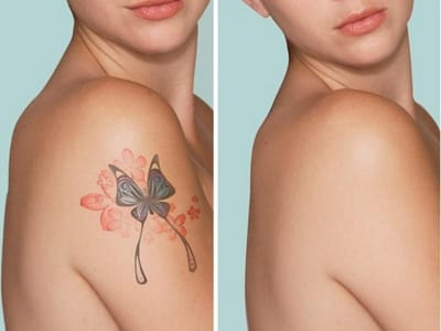 Cach xoa xam vinh vien