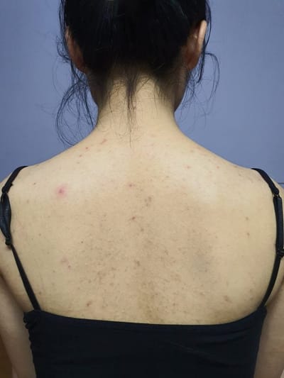 5 cach cham soc da de khong bi mun lung