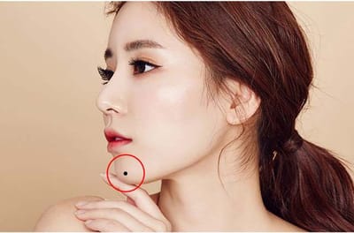 sau khi tay not ruoi lam gi de khong bi seo