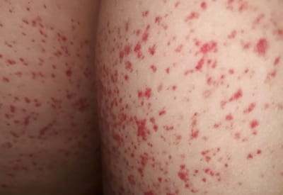 da noi cham do nhu not ruoi son khong ngua co nguy hiem khong