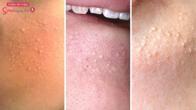 Cac loai thuoc tri mun trung ca tuoi day thi