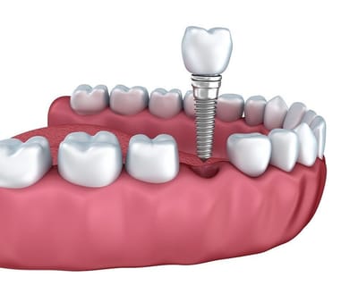 Best Implant Dentist in Ahmedabad