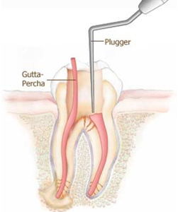 Root Canal Treatment