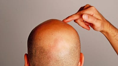 Haartransplantation- FUE - Haartransplantation image