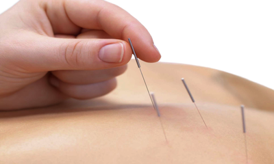 Akupunktur   image