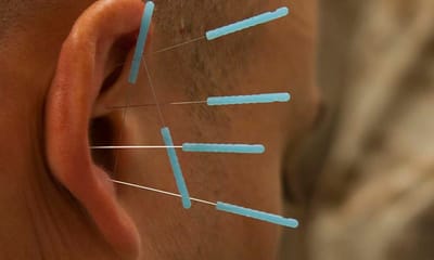 Akupunktur   image