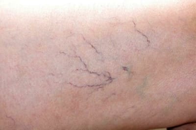 Besenreiser Entfernung-Sclerotherapy image