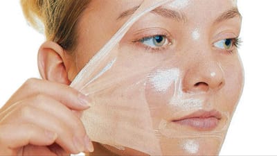 Chemisches Peeling- Chemical Peeling image