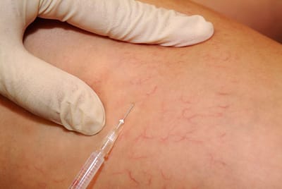 Besenreiser Entfernung-Sclerotherapy image